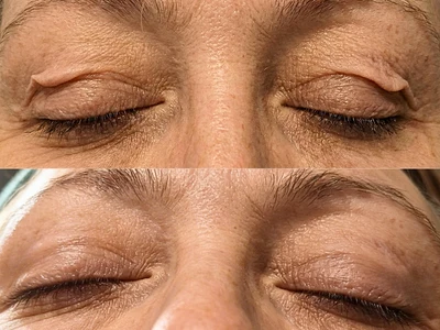 Before and after: visibly lifted, smoother eyelid skin